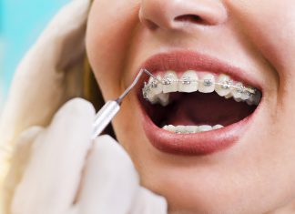 Braces vs Invisible Braces – What is the Difference?